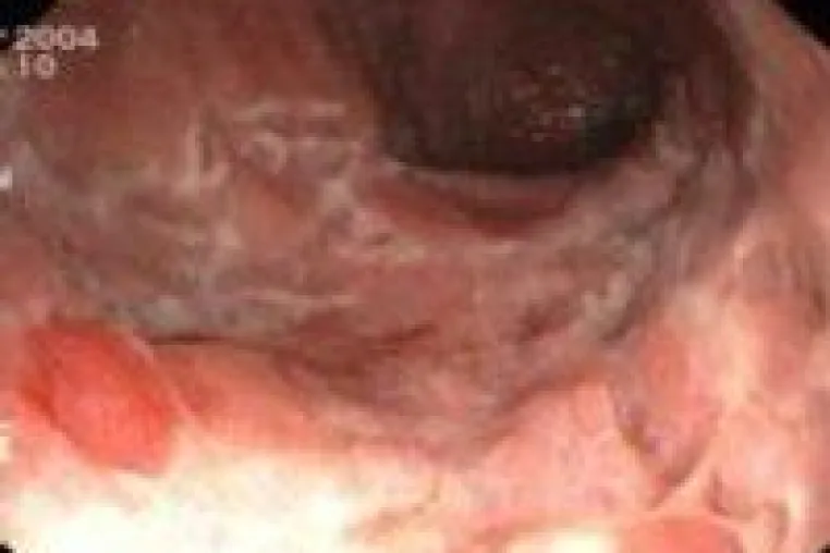 Gendefekt verantwortlich für chronische Darmentzündungen? Bild: Gendefekt verantwortlich für chronische Darmentzündungen?
