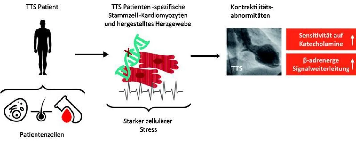 Göttinger Herzforschern ist es erstmals gelungen, genetische Ursachen bei Patienten mit dem „Broken-Heart-Syndrom“ zu identifizieren. ()