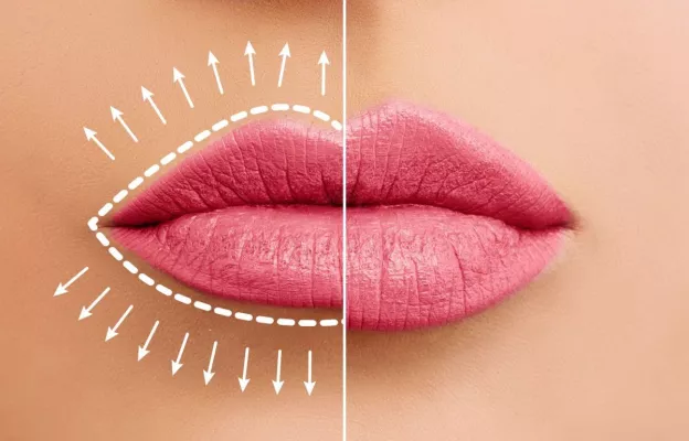 Bild: Lippenvergrößerung mit Hyaluron Filler