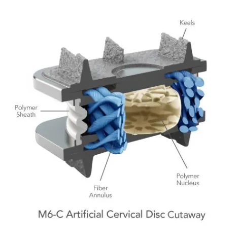 Innovative Alternative zu gängigen Bandscheibenprothesen: Die M6 Bandscheibenprothese von Spinal Kinetics Bild: Innovative Alternative zu gängigen Bandscheibenprothesen: Die M6 Bandscheibenprothese von Spinal Kinetics
