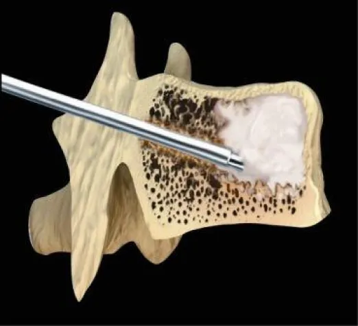 Zement, der für Bewegung sorgt - Neue Methode bei Osteoporose: Radiofrequenz-Kyphoplastie Bild: Zement, der für Bewegung sorgt - Neue Methode bei Osteoporose: Radiofrequenz-Kyphoplastie