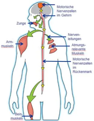 Vortrags- und Bewegungsevent zum Thema ALS im PEB2 in Eningen Bild: Vortrags- und Bewegungsevent zum Thema ALS im PEB2 in Eningen