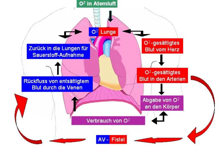 Bild: Neue Hoffnung für Patienten mit fortgeschrittenen Lungenerkrankungen (COPD) Dank neuer Behandlungsmethode