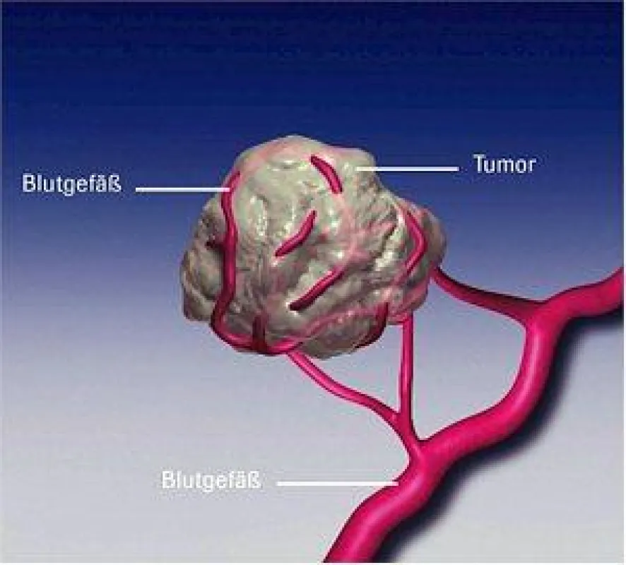 Angiogenese Hemmer Bevacizumab: Durch die kontinuierliche Hemmung der Blutgefäßneubildung wird der Tumor regelrecht \