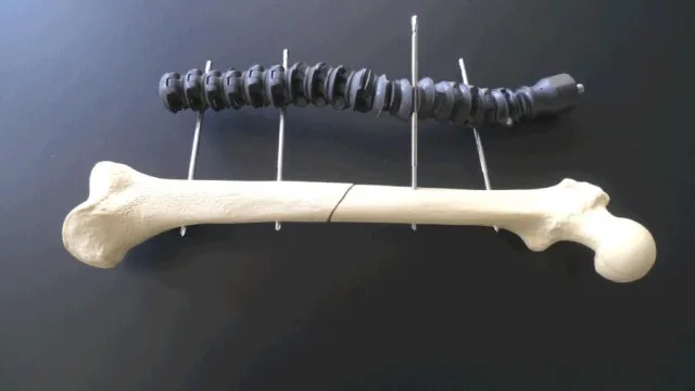 Bild: Neuartiges Fixationssystem snakeFX soll medizinische Versorgung von Schwerverletzten revolutionieren