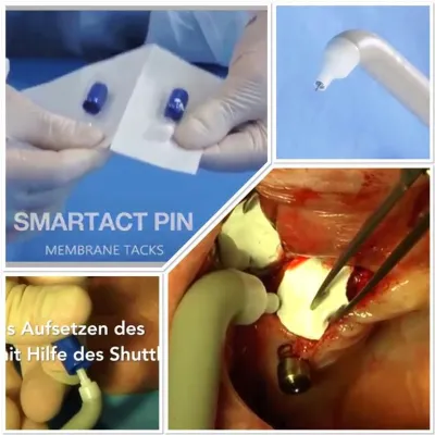 Bild: Innovativer Membranfixierer ersetzt Oralchirurgen 2 Hände und verkürzt OP Zeiten
