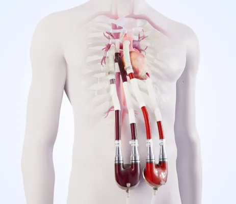 Bild: Berlin Heart gibt erste Implantation einer Überbrückungslösung bei Patienten mit Einkammerherz bekannt