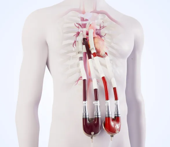 Bild: Berlin Heart gibt erste Implantation einer Überbrückungslösung bei Patienten mit Einkammerherz bekannt