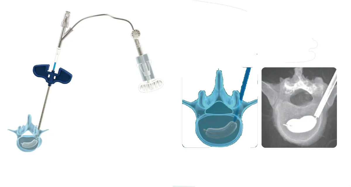 PCKP-Kyphoplastie (© Ortho Medicor AG)