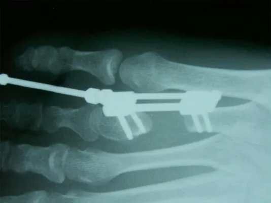 Innovation im Bereich der Fußchirurgie Bild: Innovation im Bereich der Fußchirurgie