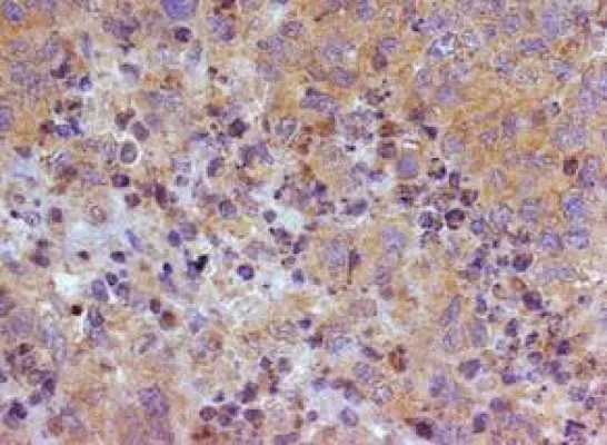 WIDERSTAND GEGEN DIE RESISTENZ – NEUE THERAPIE-CHANCEN BEI EIERSTOCKKREBS Bild: WIDERSTAND GEGEN DIE RESISTENZ – NEUE THERAPIE-CHANCEN BEI EIERSTOCKKREBS