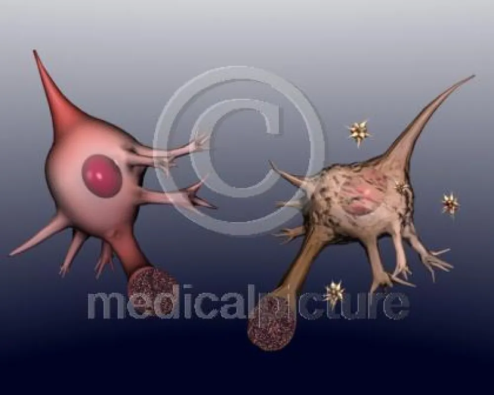Nervenzelle gesund und krank