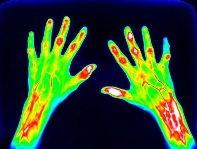Bild: mivenion und Pfizer vereinbaren Pilotprojekt zur optischen Bildgebung der rheumatoiden Arthritis