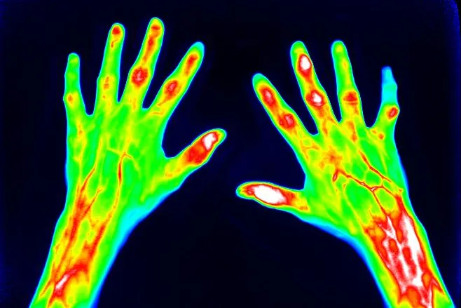 Bild: mivenion und Pfizer vereinbaren Pilotprojekt zur optischen Bildgebung der rheumatoiden Arthritis