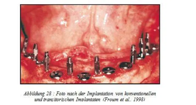 Bild: Festsitzender provisorischer Zahnersatz während der Einheilzeit von Dauerimplantaten