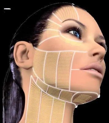 Bild: Lifting ohne Skalpell: Ultherapy ist die bisher einzige nicht-invasive Hautliftingmethode