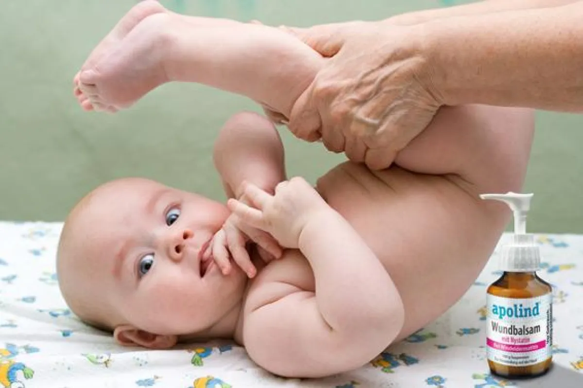 Apolind Wundbalsam mit Nystatin auf Erdnußölbasis kann sanft und natürlich bei Windeldermatitis helfen
