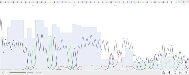 Bild: Neues Risikogen bei chronischer Entzündung der Bauchspeicheldrüse identifiziert