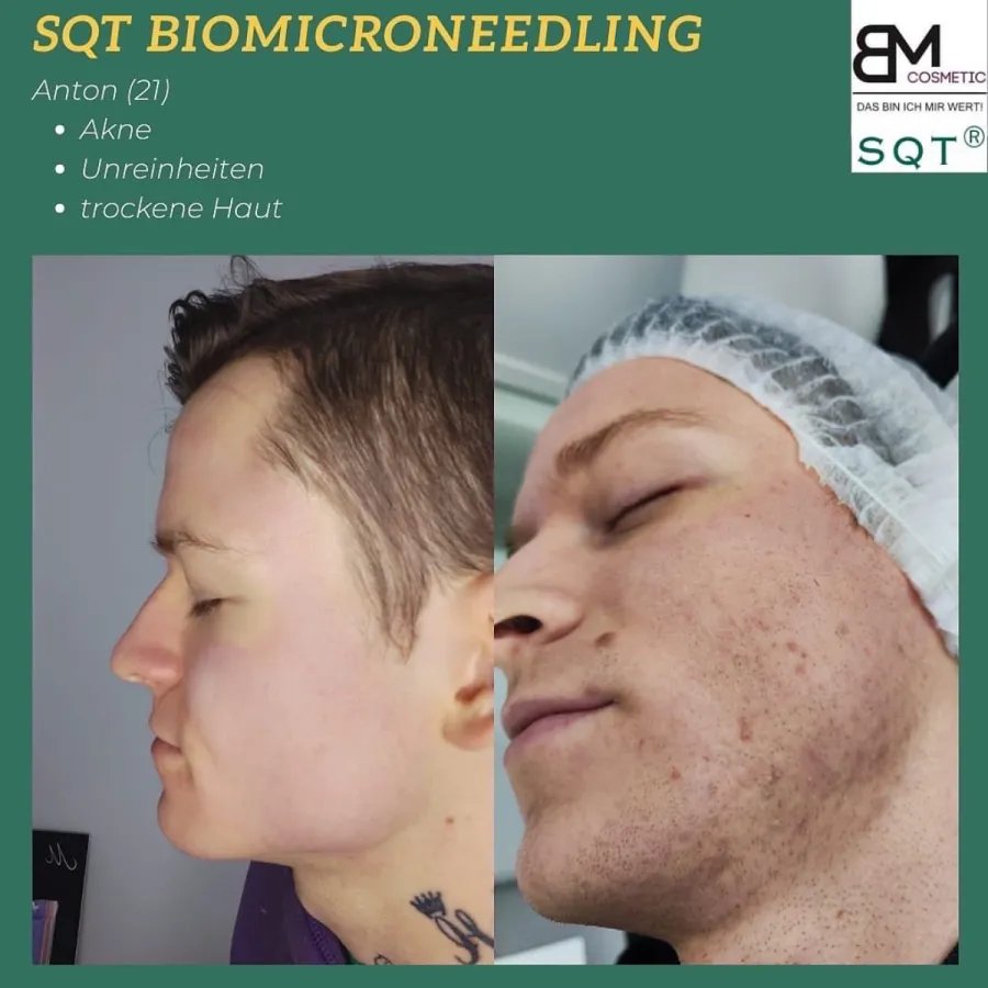 Akne Behandlung next level - SQT Biomicroneedling (© BM colours GmbH)