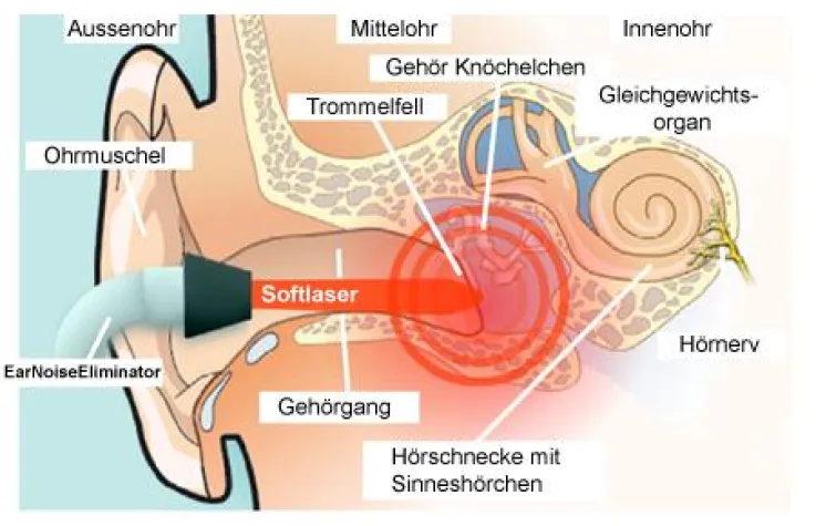 Bild: Tinnitus erfolgreiche Selbstbehandlung durch Softlasertherapie mit EarNoiseEliminator bei Tinnitus