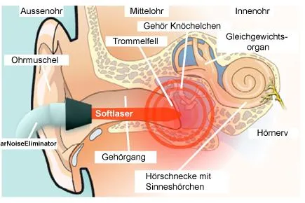 Bild: Tinnitus erfolgreiche Selbstbehandlung durch Softlasertherapie mit EarNoiseEliminator bei Tinnitus