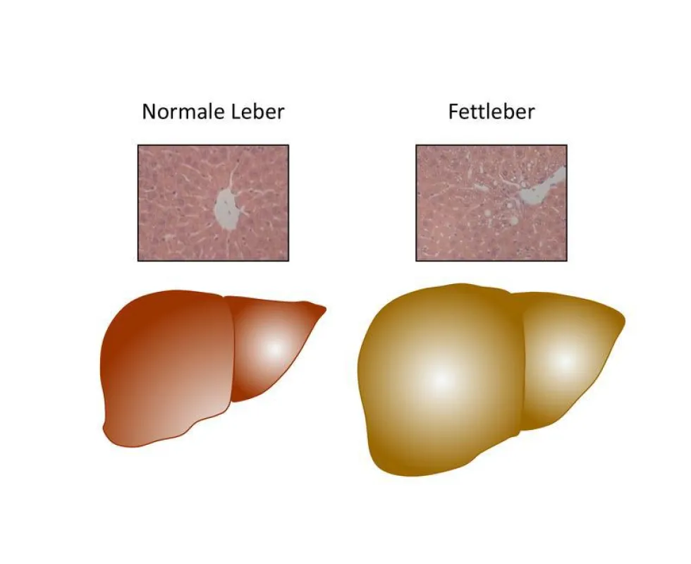 A healthy liver (left) can develo a steatosis (right). (Image UZH)