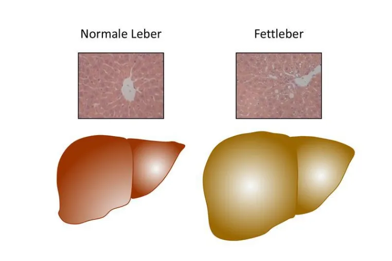 Bild: Trigger for Fatty Liver in Obesity