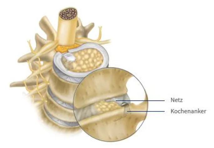 Ein Bandscheibenvorfall kann jeden treffen. Bild: Ein Bandscheibenvorfall kann jeden treffen.