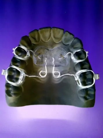 Bild: Außenbogen, Pendulum & Co. – die Platzschaffer in der Kieferorthopädie