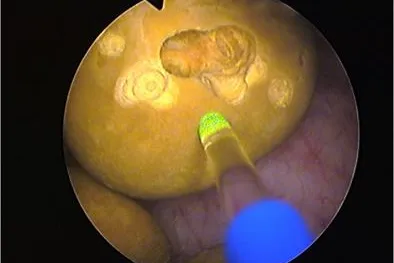 Doppelte Laser-Therapie: Schmerzhafte Blasensteine schonend zerstören Bild: Doppelte Laser-Therapie: Schmerzhafte Blasensteine schonend zerstören
