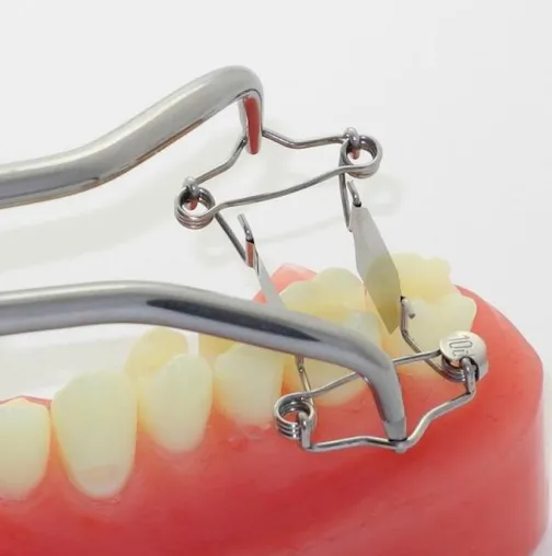 Dr. Walser Dental entwickelt neue Zahn-Matrize für extra tiefe Karies an einer Seite Bild: Dr. Walser Dental entwickelt neue Zahn-Matrize für extra tiefe Karies an einer Seite