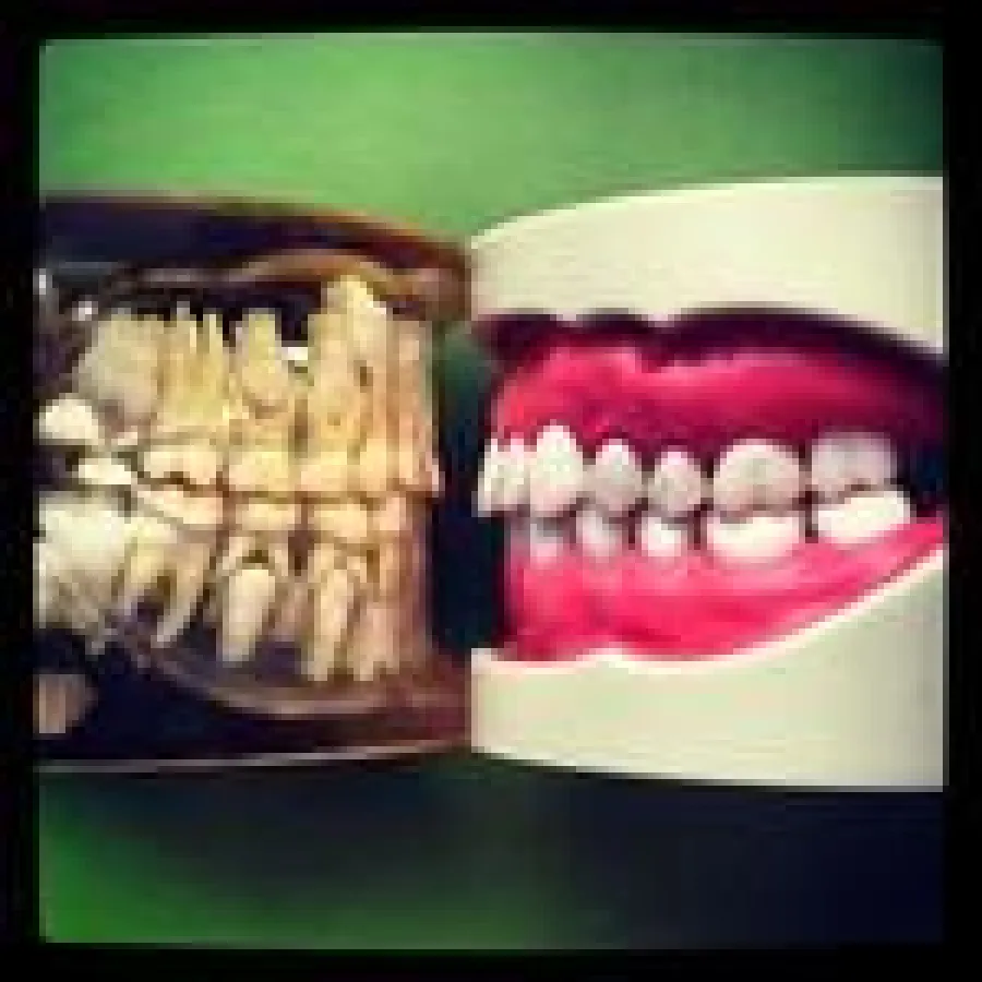 Wechselgebiss vs. permanentes Gebiss