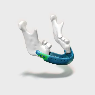 Bild: docq VIT - virtuelle Implantatprüfung mit Simulation