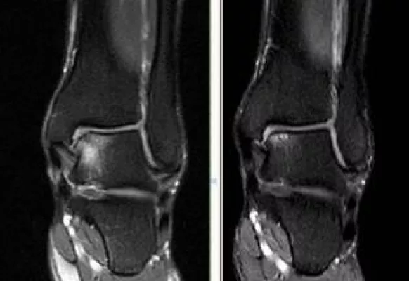 Bild: Bei Knochenmarködemsyndrom, Hüftkopf- oder Fußwurzelnekrose und Morbus Ahlbäck: In die Sauerstoff-Druckkammer