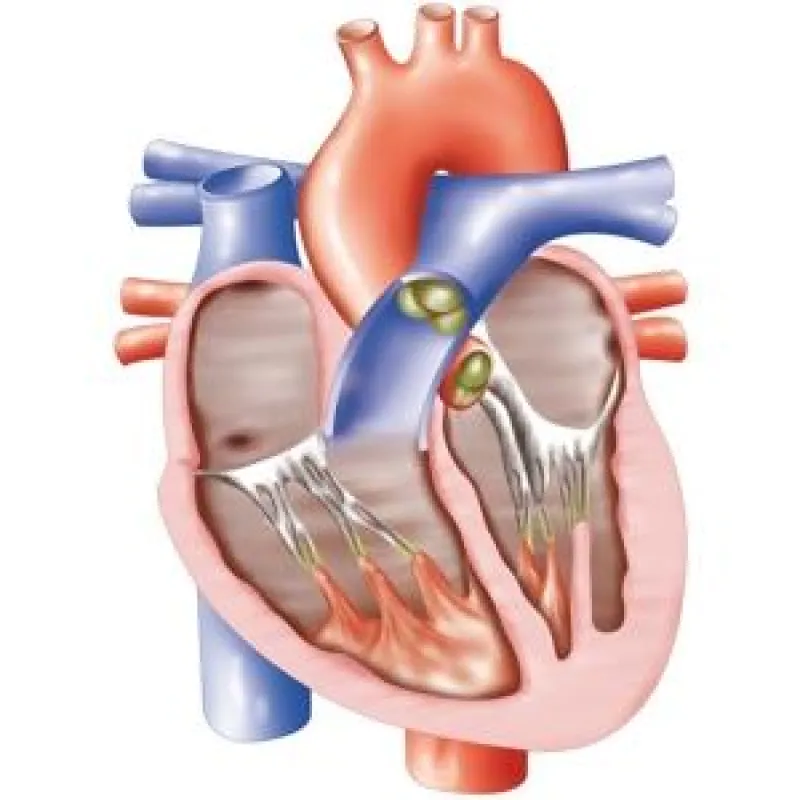 Myokarditis