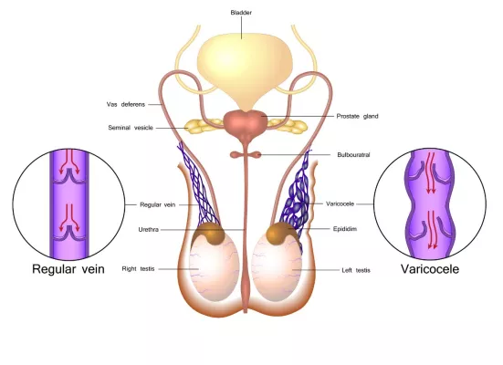 Bild: Varikozele - Behandlung von Krampfadern im Hoden