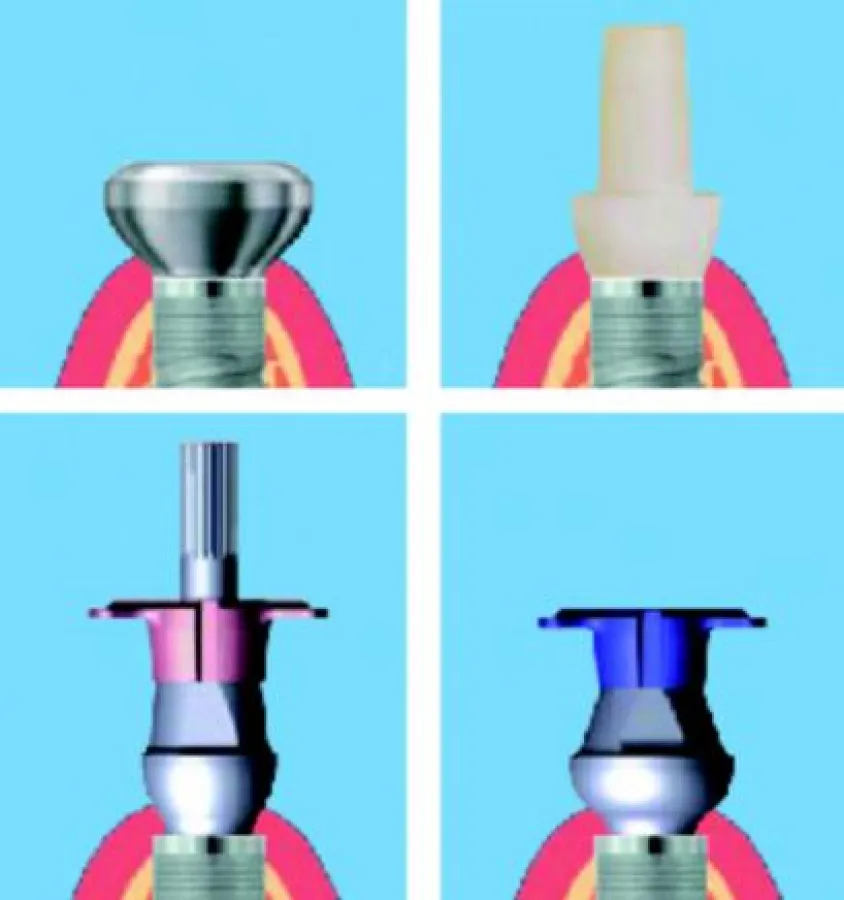 SKY esthetic Abformabutments von bredent