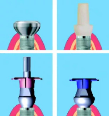 SKY esthetic Abformabutments: bredent medical zeigt Ästhetik im System Bild: SKY esthetic Abformabutments: bredent medical zeigt Ästhetik im System