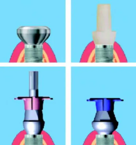 Bild: SKY esthetic Abformabutments: bredent medical zeigt Ästhetik im System