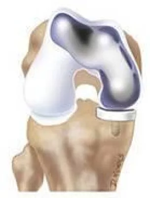 ConforMIS erhält CE-Zertifizierung für patientenspezifischen bikompartimentellen Knie-Oberflächenersatz iDuo Bild: ConforMIS erhält CE-Zertifizierung für patientenspezifischen bikompartimentellen Knie-Oberflächenersatz iDuo