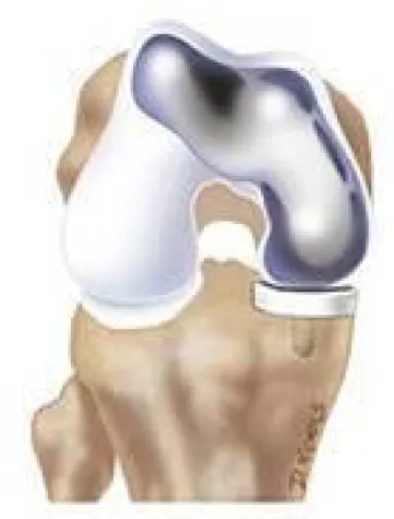 ConforMIS erhält CE-Zertifizierung für patientenspezifischen bikompartimentellen Knie-Oberflächenersatz iDuo Bild: ConforMIS erhält CE-Zertifizierung für patientenspezifischen bikompartimentellen Knie-Oberflächenersatz iDuo