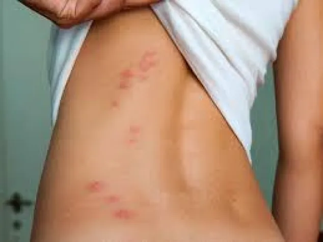 Bild: Bettwanzen Stiche