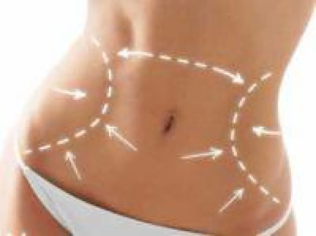 Vitalitas Bauchstraffung