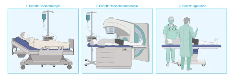 Bild: Weltpankreaskrebstag: Studie erzielt Fortschritte für Betroffene – Forschungsbedarf weiterhin enorm