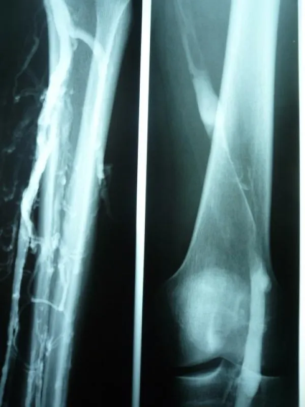 frische 3 -Etagen-Thrombose