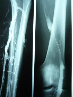 Thrombosen der Beinvenen können wieder eröffnet werden Bild: Thrombosen der Beinvenen können wieder eröffnet werden