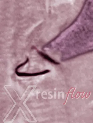 Bild: Röntgenopaker X-resin flow: Prothetisch orientiert, einfach und schnell