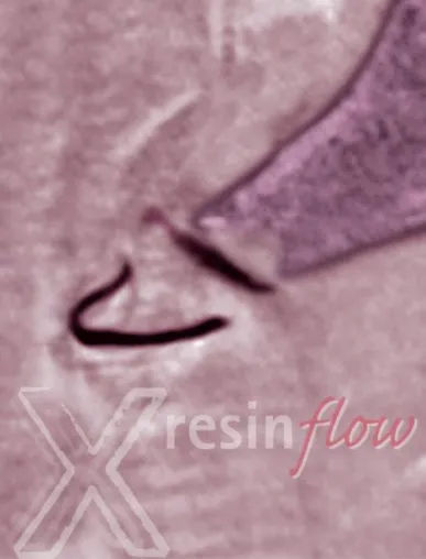 Bild: Röntgenopaker X-resin flow: Prothetisch orientiert, einfach und schnell