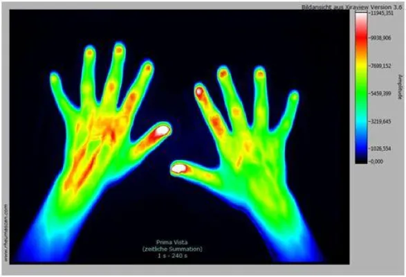 Bild: Weltweit erster Rheumascan in der Kinderrheumatologie: Frühdiagnostik und Therapiekontrolle jetzt effektiver