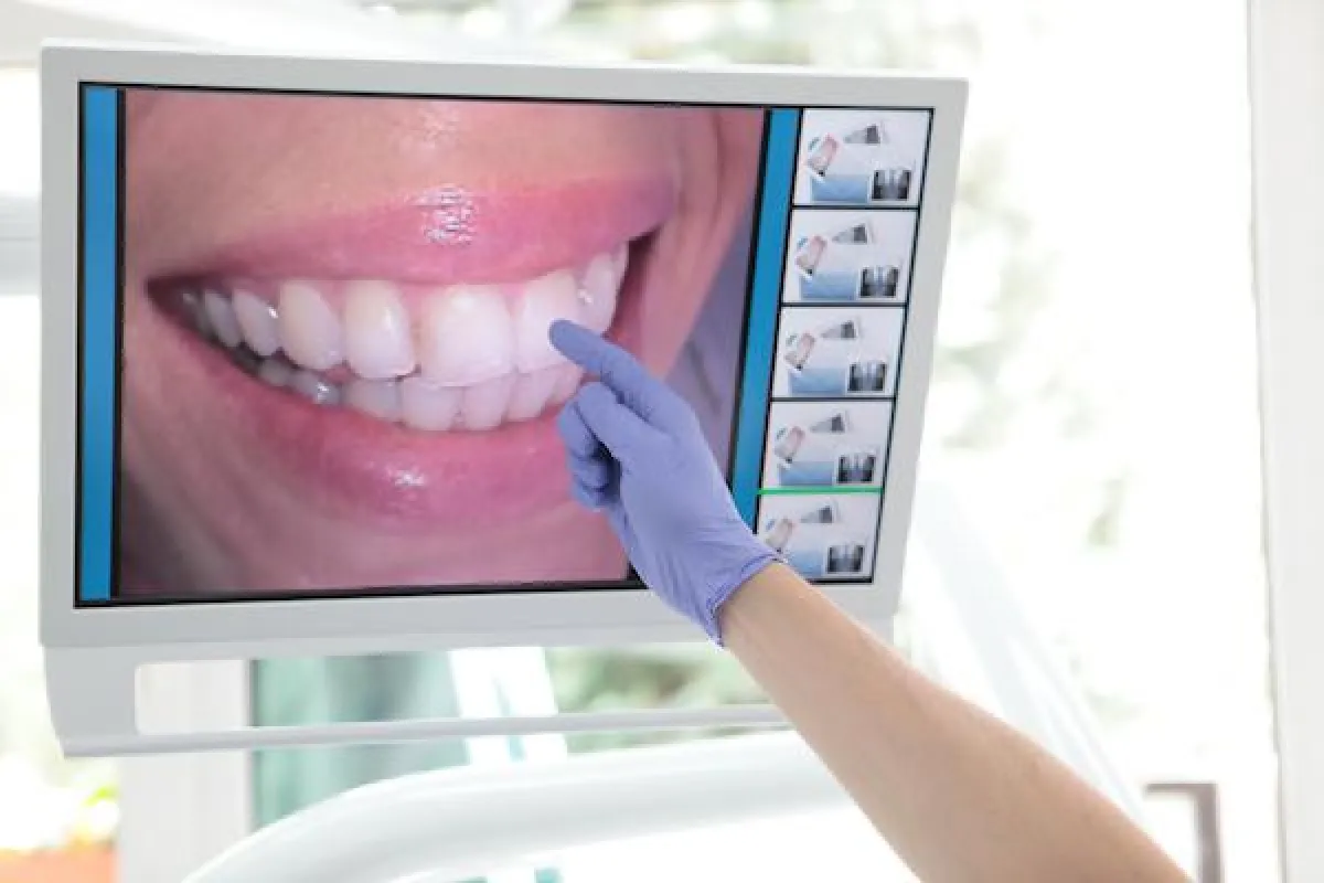 Webinar zum Thema Zahnfleischlifting